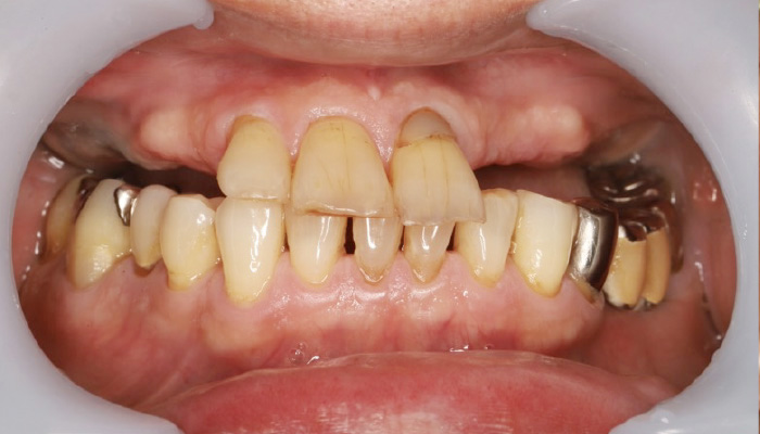 義歯治療の症例