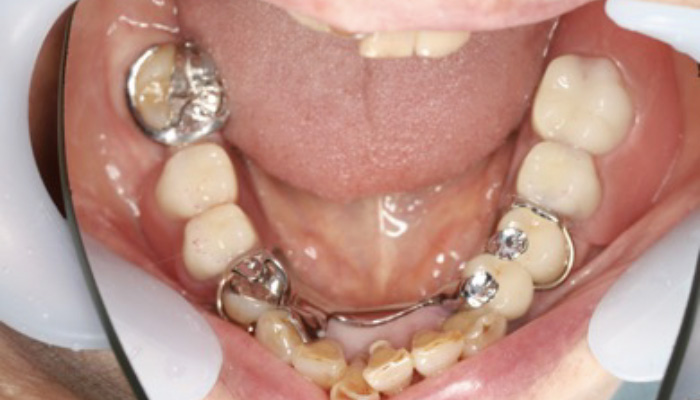 義歯治療の症例