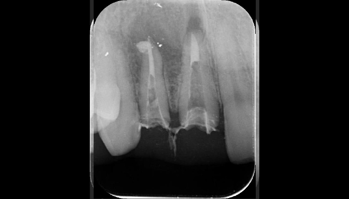 根管治療の症例