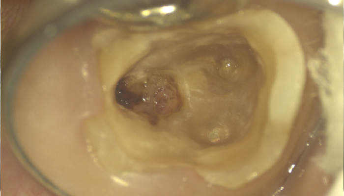 根管治療の症例
