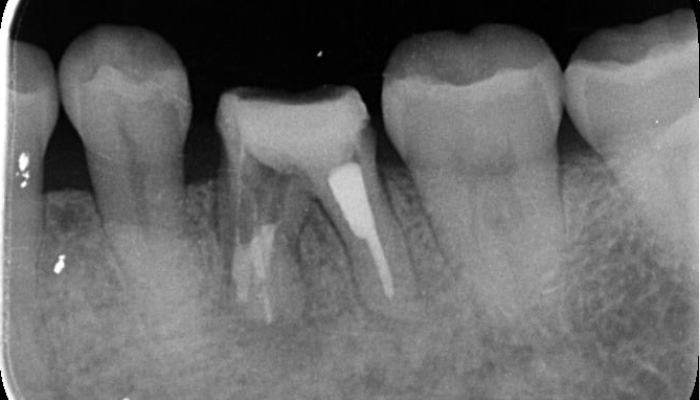 根管治療の症例