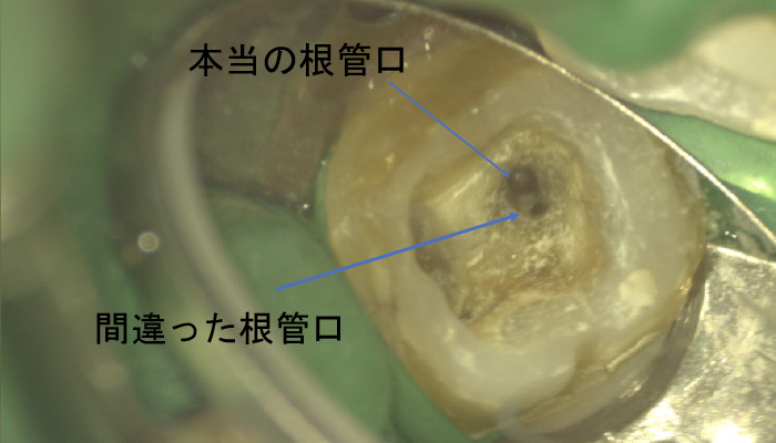 根管治療の症例