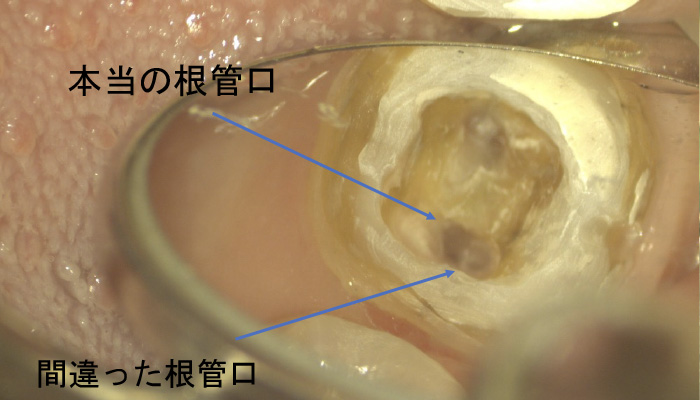 根管治療の症例