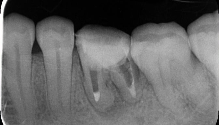 根管治療の症例